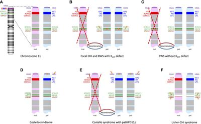 Syndromic forms of congenital hyperinsulinism